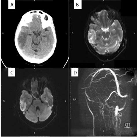 Ct Brain Showing Right Temporal Lobe Hypodensity Mri Brain T2