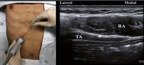 Bloqueo Tap Abordaje Subcostal Tomado De Transversus Abdominis Plane