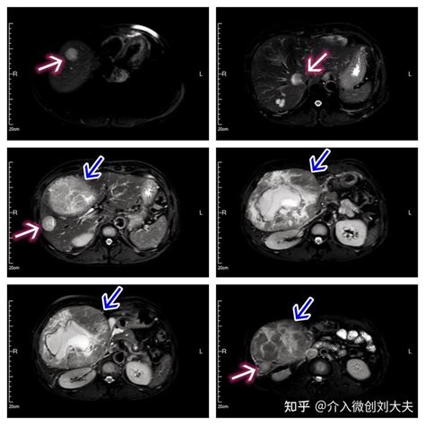 介入栓塞联合靶免治疗中晚期肝癌 知乎