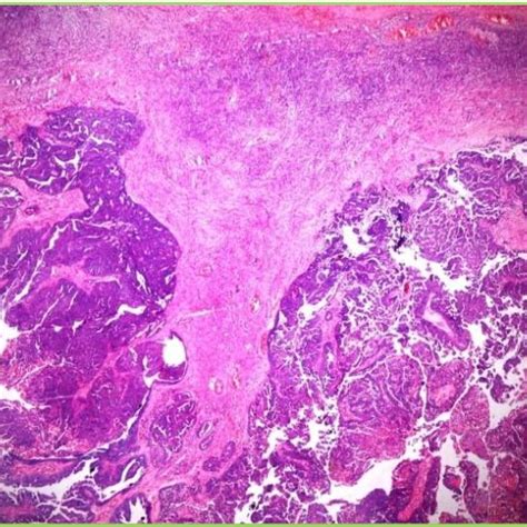 Pdf Bilateral Ovarian Serous Cystadenocarcinoma Metastasizing To Cervix A Rare Case Report