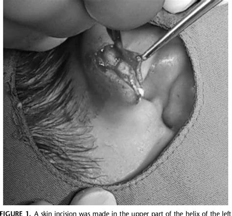 Figure From Idiopathic Auricular Calcinosis Cutis Semantic Scholar