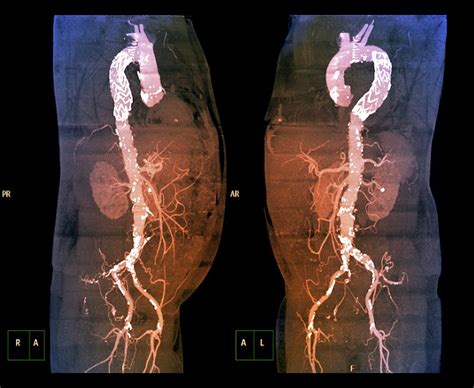 Stent In Aortic Aneurysm Photograph by Zephyr/science Photo Library ...