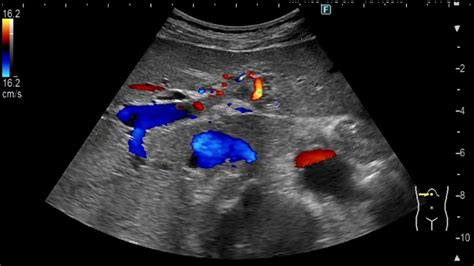 Portal Vein Tumor Thrombosis Peribiliary Cyst Renal Cell Carcinoma