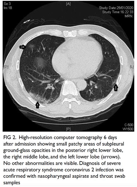 High Resolution Computed Tomography In A Patient With Covid 19 With Non