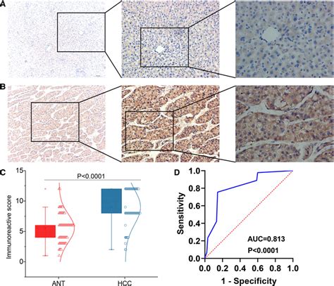 Chst11 Protein Expression Pattern In Hepatocellular Carcinoma Hcc Download Scientific