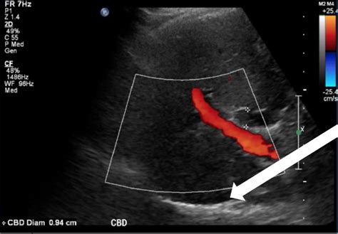 A Case Report On Detecting Porcelain Gallbladder Form Wall Echo Shadow