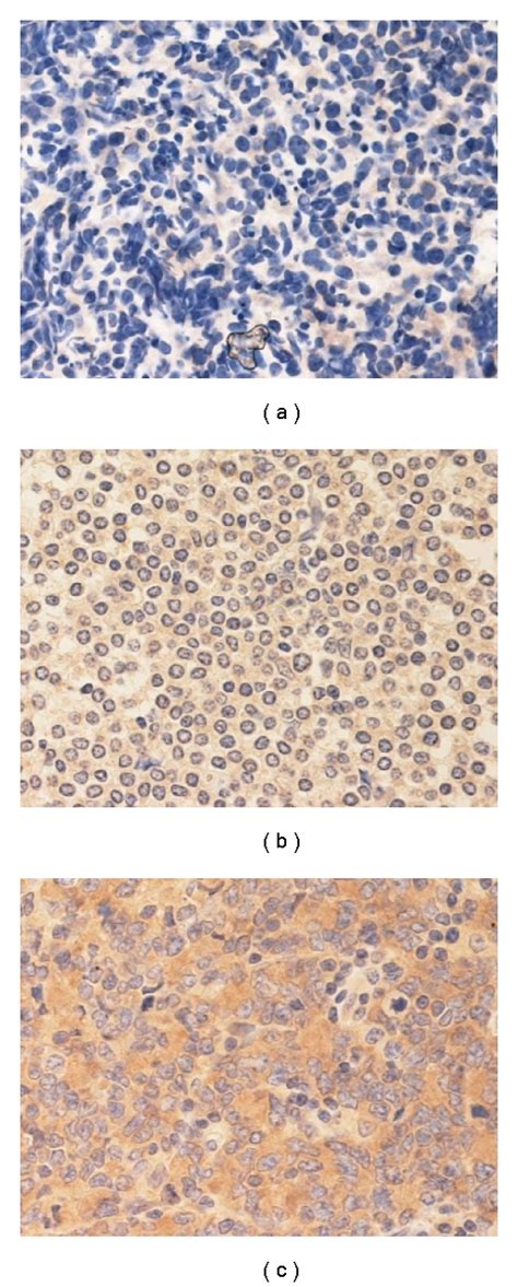 Immunohistochemical stains of lymphoma tissues (a) negative, (b ...