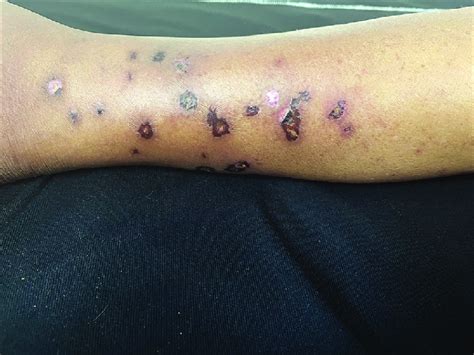 Lesions showing crusting after ten days of treatment | Download Scientific Diagram