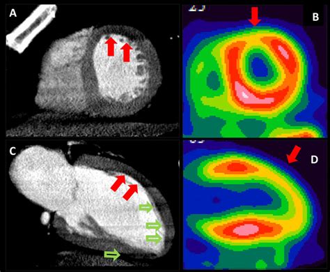 Stress Ct Mi And Rb Pet Agreement By Visual Analysis Post