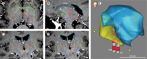 Safety And Efficacy Of Dual Lead Thalamic Deep Brain Stimulation For