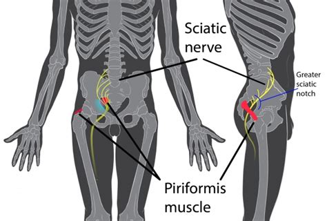 Piriformis syndrome - WikEM