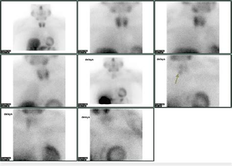 99mTc Sestamibi Scintigraphy Sestamibi Scan Showing Abnormal