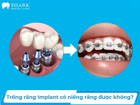 Trồng răng Implant có niềng răng được không