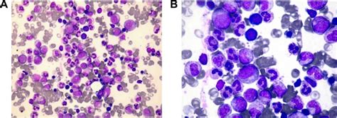 A Case Of Chronic Neutrophilic Leukemia Successfully Treated With