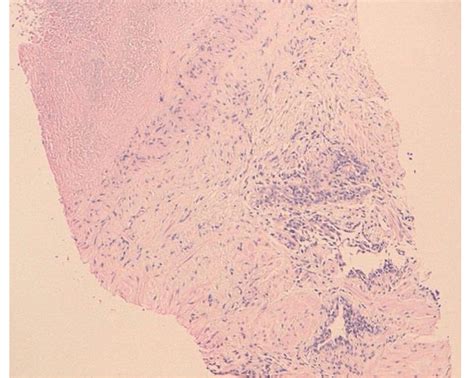 Histology Prostatic Parenchyma Seat Beaches Caseous Necrosis That Is Download Scientific