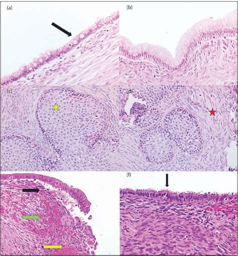 Hande Photomicrographs Of Benign Epithelial Ovarian Neoplasms Original