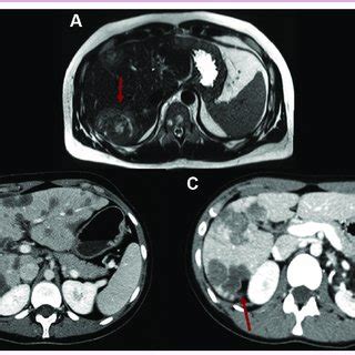 Hepatic Epithelioid Hemangioendothelioma EHE A T2 Weighted