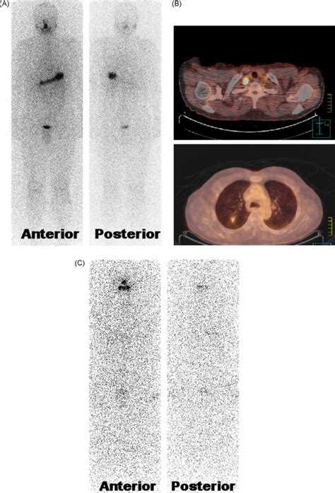 Clinical Implication Of F 18 FDG PET CT For Differentiated Thyroid