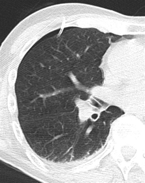 Complications Of Ct Guided Percutaneous Needle Biopsy Of The Chest Prevention And Management Ajr