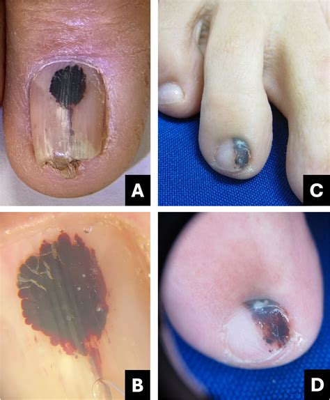 Differential diagnosis of pigmented nail lesions | Anais Brasileiros de