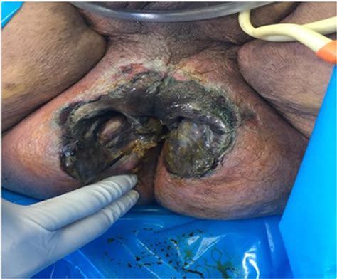 Figure 1 From Fourniers Gangrene As A Rare Complication In Patient