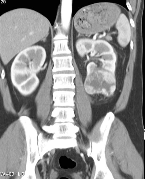 Renal Cell Carcinoma Image