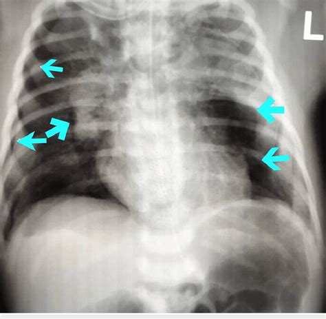 Chest X-ray, arrows demonstrating the presence of the large ...