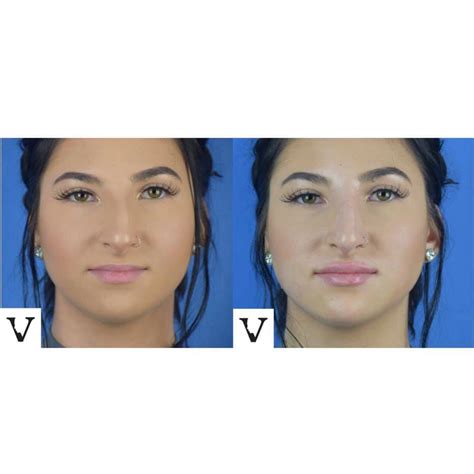 Asymmetrical Face Correction Makes Your Beautiful Jawline Visage