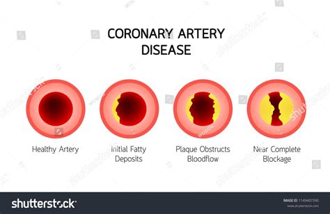 85 Stages Blocked Artery Vector Images, Stock Photos & Vectors ...