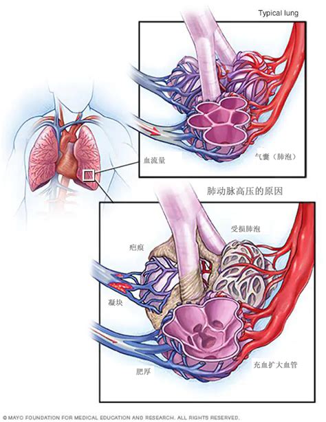 5分钟带您认识肺动脉高压 知乎