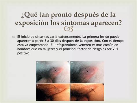 Linfogranuloma Venéreo Ppt