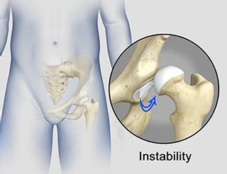 Hip Instability Treatment Grand Junction Co Hip Dysplasia Mesa County