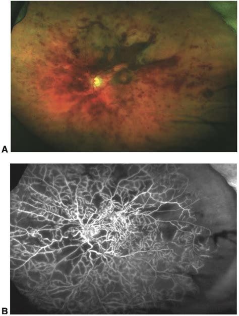 Oclusão Venosa Da Retina Blog Da Oftalmomaster