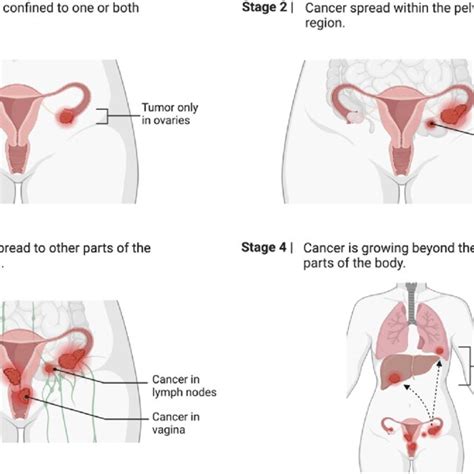 Ovarian Cancer Staging Created With Download