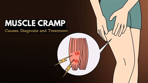 What Causes Muscle Cramps?