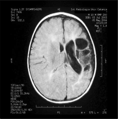 Porencephalic Cyst Mri