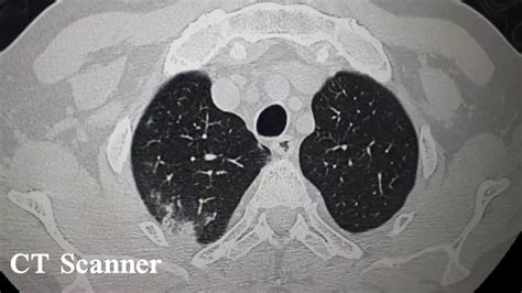 Covid Plages De Verre D Poli Scanner Thoracique Youtube