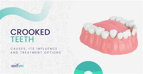 Crooked Teeth Causes Its Influence And Treatment Options Dentspa