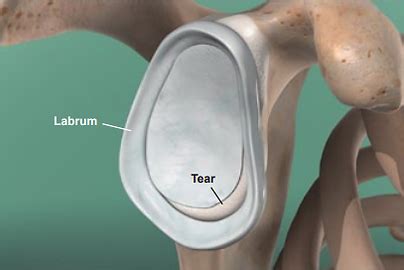 NorTex Spine & Joint Institute | Glenoid Labrum Tear