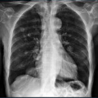 Chest Radiography Posterior Anterior Incidence With Several Bilateral