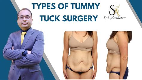 Different Types Of Tummy Tuck Surgery Abdominoplasty Types Youtube