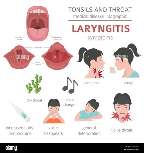 Enfermedades De La Garganta Y Las Am Gdalas Los S Ntomas De La