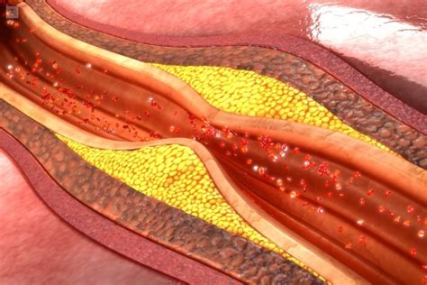 Dislipidemia qué es síntomas y tratamiento Top Doctors