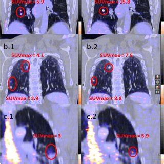 Mean Suvmax Metabolic Tumor Volume Mtv And Total Lesion Glycolysis