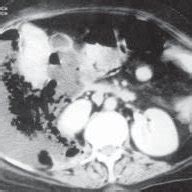 CT scan of the abdomen showing a large right sided retroperitoneal abscess | Download Scientific ...