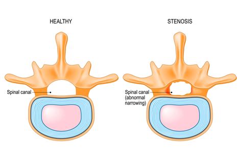 Stenosis Hey Clinic