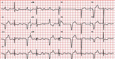 emDOCs.net – Emergency Medicine EducationECG6 - emDOCs.net - Emergency ...