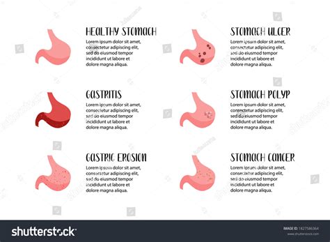 Stomach Diseases Gastritis Gastric Erosion Ulcer Stock Vector Royalty Free 1827586364