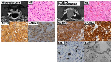 Jcm Free Full Text Cushings Disease