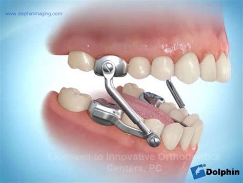 Appliances Innovative Orthodontic Centers